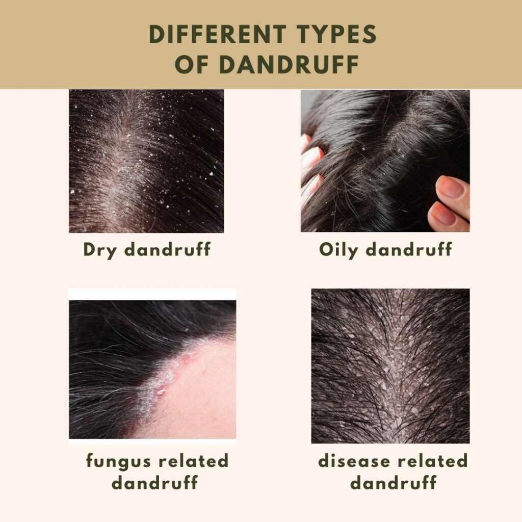 Different types of dandruff with causes and treatment options illustrated
